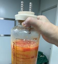 张北水动力吸脂手术要做多久？